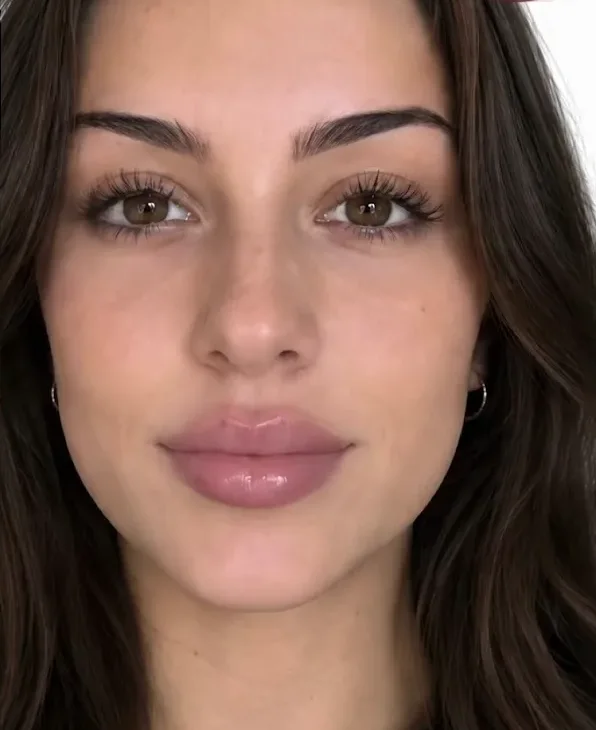 After lip filler