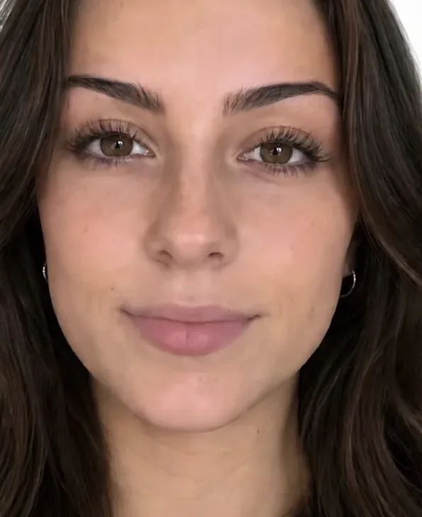 Before lip filler